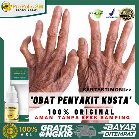 Jual Obat Penyakit Kusta Obat Herbal Kusta Basah Kusta Kering