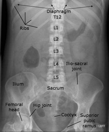 Coccyx X Ray Positioning - IrvinnCesey