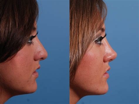 Bulbous Tip Rhinoplasty