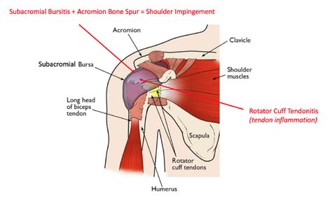 Subdeltoid Bursitis