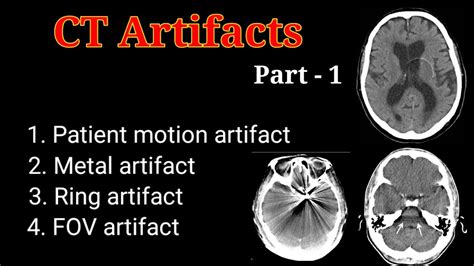 Ct Scan Artifacts Part 1 Computed Tomography English Hindi