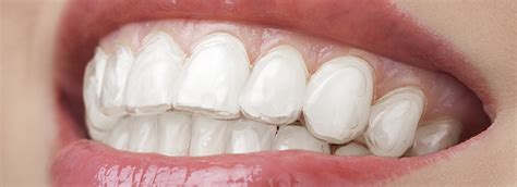 Carillas De Composite Inyectadas Cl Nica Dental Bizkaia