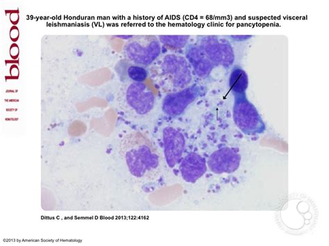 Leishmania Amastigotes Visualized On Bone Marrow Aspirate In A