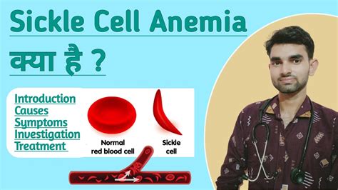 Sickle Cell Anemia In Hindi Causes Symptoms And Treatment Of Sickle