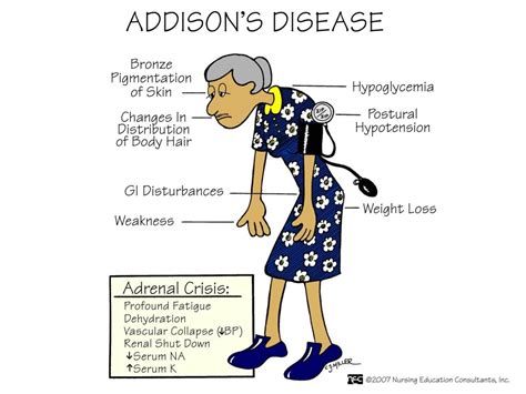 Conn S Syndrome Vs Addison S Disease Pregnancy Depression