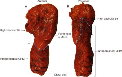 Anterior Resection Specimen For Rectal Cancer Demonstrating The Download Scientific Diagram