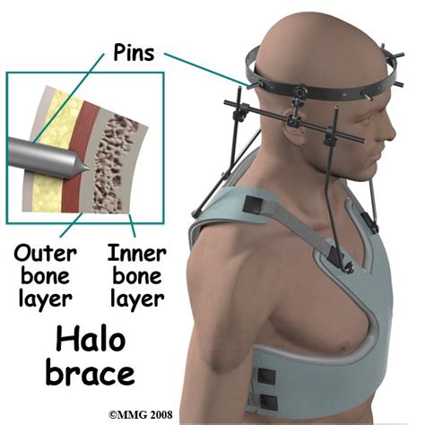 Halo Femoral Traction Halo Brace Nclex Review Nclex Rn Acute Care