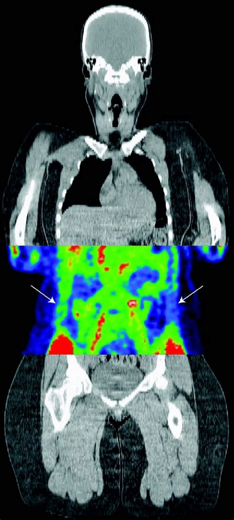 Positron emission tomography and computed tomography images of patient ...