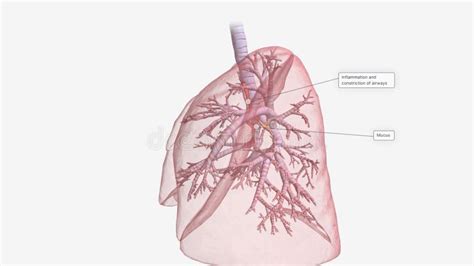 Inflammation and Constriction of Airways Stock Illustration ...