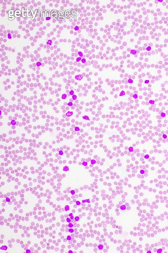 Acute Lymphocytic Leukemia Or All Cells In Blood Smear 이미지 1313658101