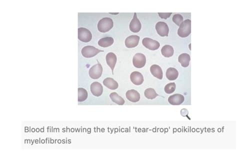 Myeloproliferative Disorders Flashcards Quizlet