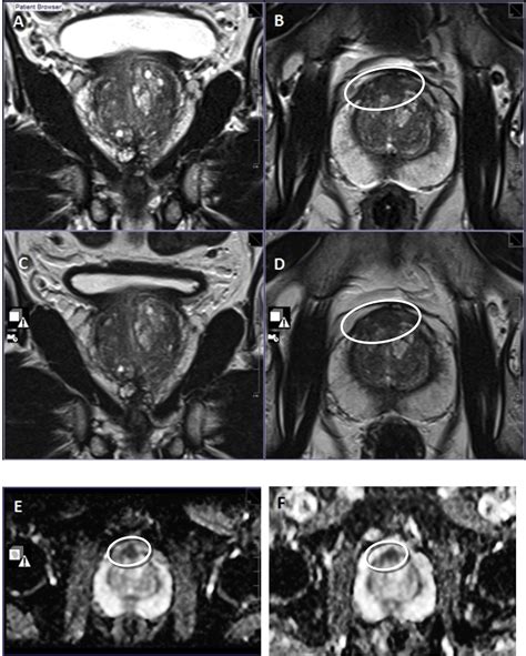 Multiparametric Magnetic Resonance Imaging For The Detection Of