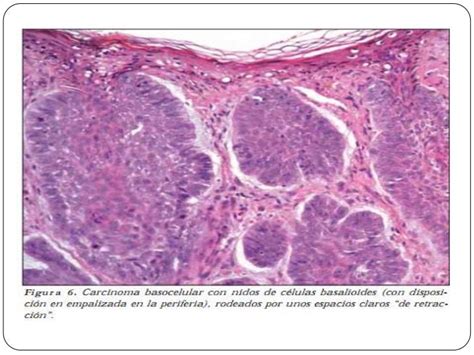 Carcinoma Basocelular