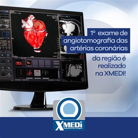 1º exame de angiotomografia das artérias conorárias