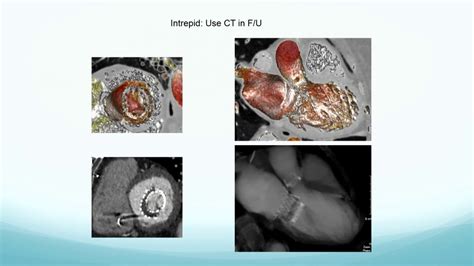 Procedural Planning For TMVR With CT John Lesser MD YouTube