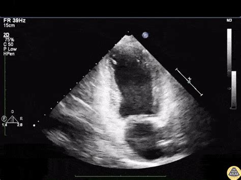 Echocardiography TPA