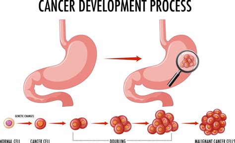 Diagram Showing Cancer Development Process Vector Image