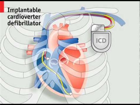 Cardiac Pacemaker