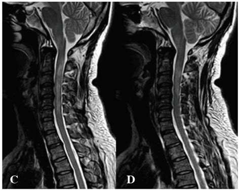 Neuromyelitis Optica NMO