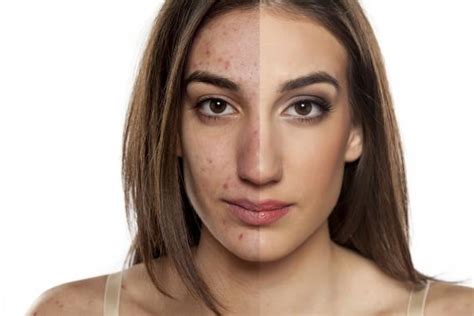 How Can Acne Affect Your Self Esteem Health Talks