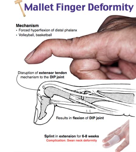 Rheum Ortho Pance Flashcards Quizlet