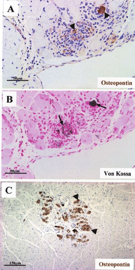 Immunohistochemical Localization Of Osteopontin And Decorin In Advanced