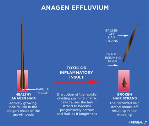 Anagen Effluvium Gl Perrault Md Hair Loss And Hair Restoration