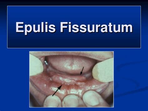 Soft Tissue Tumors 1 2007