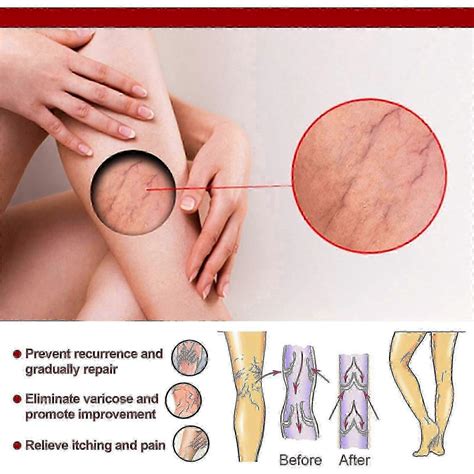 Varicose Vein Massage Cream Relieves Leg Blood Vessel Bulging Calf