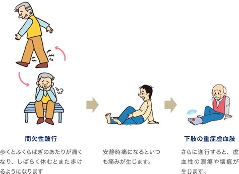 閉塞性動脈硬化症について 慶應義塾大学血管班