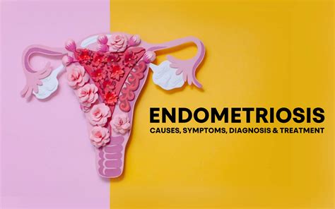 Endometriosis: Whats Really Going On