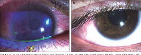 Figure 1 From Keratitis With Elizabethkingia Meningoseptica Occurring After Contact Lens Wear A