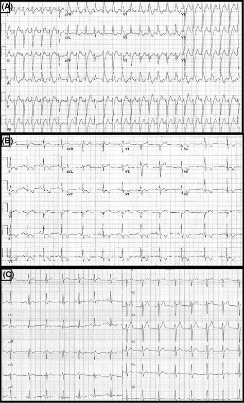 A, Initial 12‐lead ECG obtained at urgent care center. B, Repeat ...