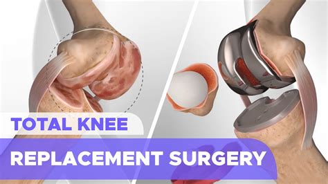 Total Knee Replacement Surgery Knee Arthroplasty Youtube