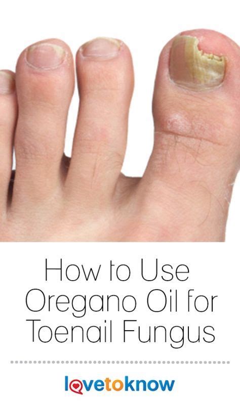 How To Use Oregano Oil For Toenail Fungus Lovetoknow Toenail Fungus Essential Oils Toenail