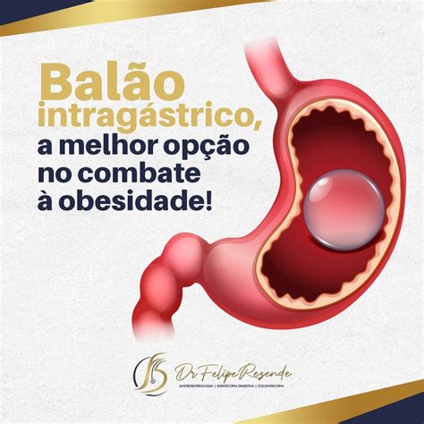 Dr Felipe Rezende Blog Balão Intragástrico A Melhor Opção No