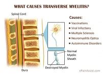 transverse-myelitis-causes - Birkdale Neuro