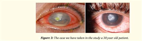 Staphylococcal Marginal Keratitis