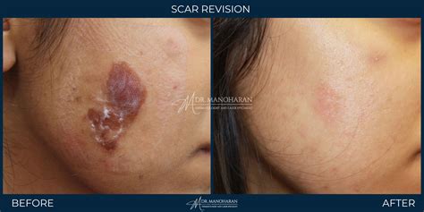 Scar Revision Before And After Photos Dermatology Clinics Australia