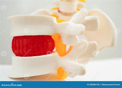 Modelo De Fragmento De Disco Herniado Desplazado De La Columna Lumbar