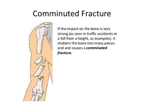 Comminuted Fracture Causes Lessonsqas