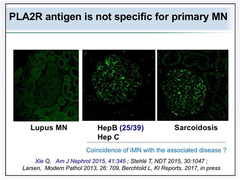 Edgar V Lerma 🇵🇭 On Twitter Membranous Nephropathy Discovery Of Pla2r And Thsd7a Has Led To