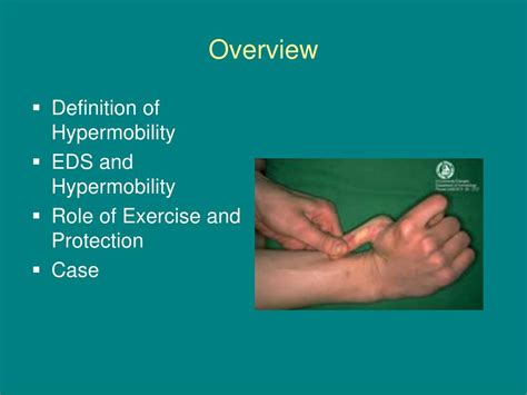 Ppt Physical Therapy Management Of The Hypermobile Patient Powerpoint