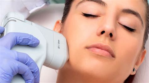 Cómo hacer lifting facial a tus pacientes con HIFU