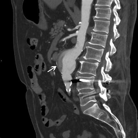 Image Abdominal Aortic Aneurysm Ct Scan Merck Manuals Professional Edition