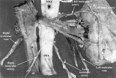 Figure 1 From A Case Of An Accessory Testicular Artery Semantic Scholar