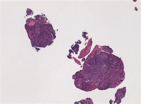 Germinoma pathophysiology - wikidoc