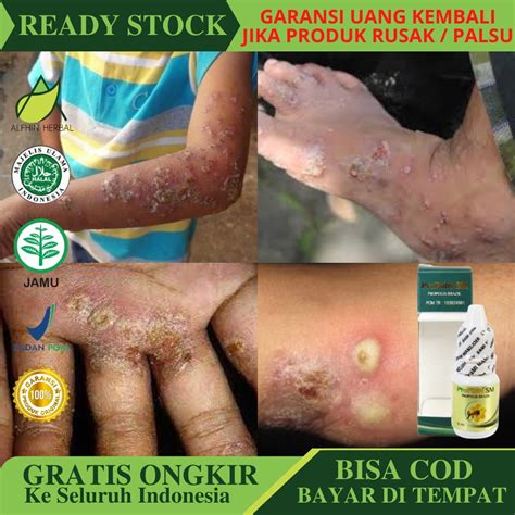 Jual Obat Tetes Budug Bernanah Budug Di Tangan Dan Kaki Obat Cenang