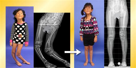 Limb Lengthening Experts In Baltimore Maryland Usa International