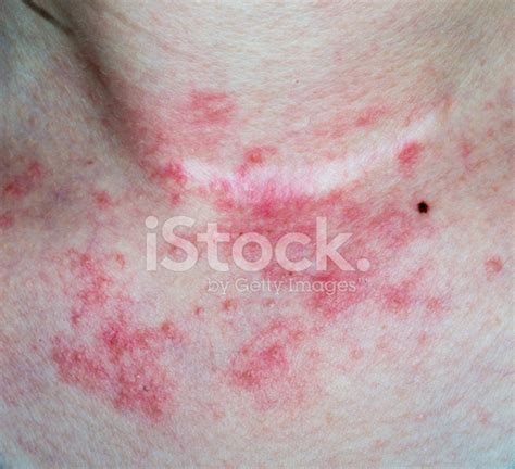 Eczema Skin on Neck Stock Photos - FreeImages.com